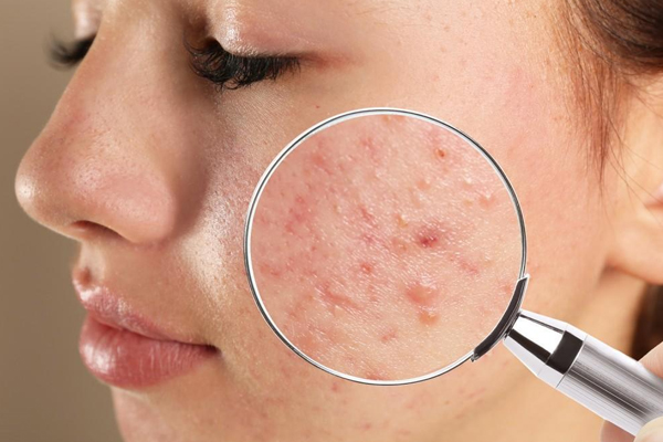 Effects of UV Rays on Skin and Hair  By Dr. Sheenam